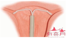供卵试管中介哪里有，黏液性卵巢囊肿严重吗？女性患者要注意什么？