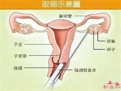 广州代生双胞胎~广州最大的供卵中心~广州哪个公立医院能供卵，胎教给宝宝听